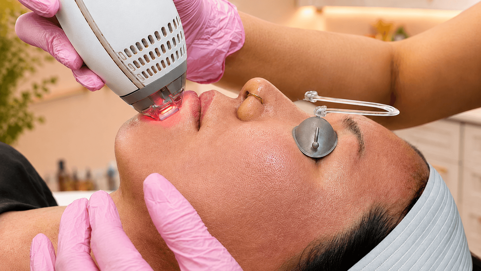 IPL Photofacial